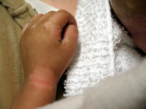 skin burned from chemo